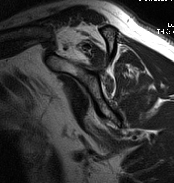 MRI Supraspinatous Atrophy